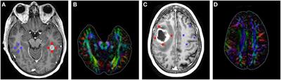 <mark class="highlighted">High-grade Gliomas</mark> Exhibit Higher Peritumoral Fractional Anisotropy and Lower Mean Diffusivity than Intracranial Metastases